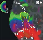 V6 come appare nelle risonanze magnetiche funzionali realizzate dai ricercatori bolognesi