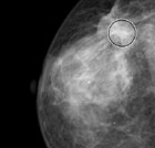 Porzione di una mammografia in cui Galileo ha cerchiato un'opacità